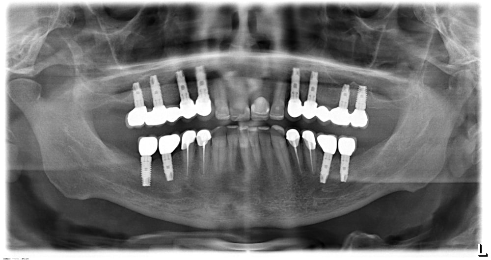 Реставрация зубов в невской стоматологии