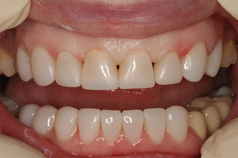 Реставрация зубов в невской стоматологии